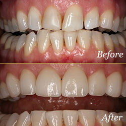 Dental Veneers - Before & After Dental Veneers - Before & After