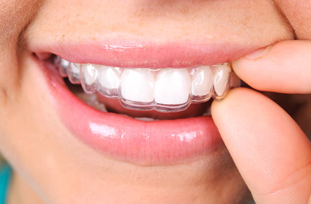 Invisalign: The clear way to straighten a smile - Dentist on Dundas