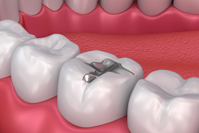 Routine Fillings - Horton Dental