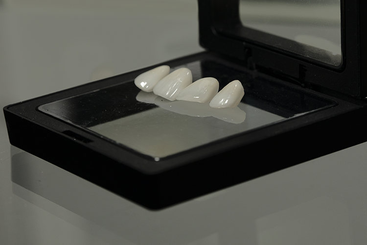 Dental Veneers and Dental Laminates in Mesa, AZ Robert Baker