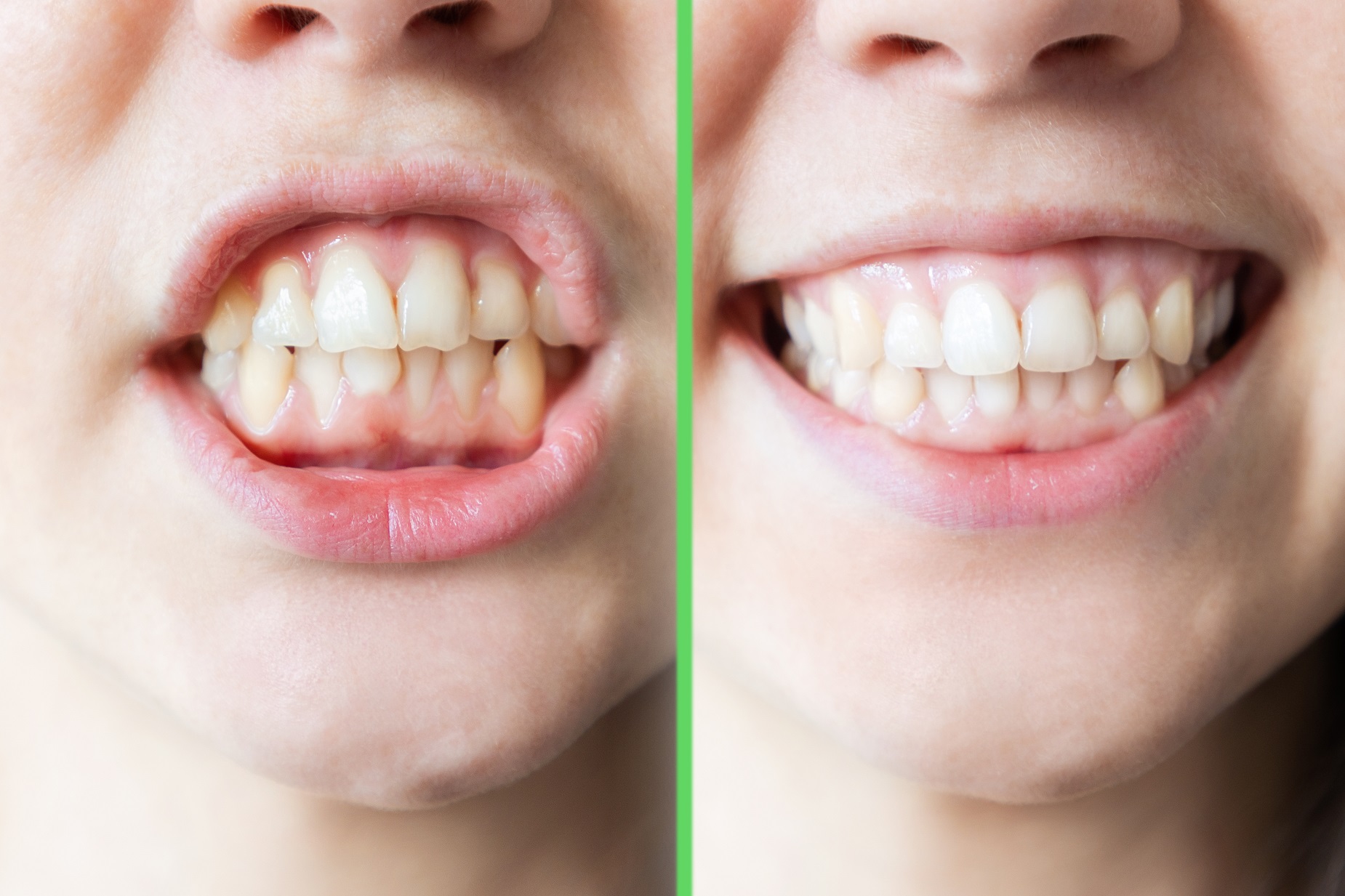 invisalign endeavour hills