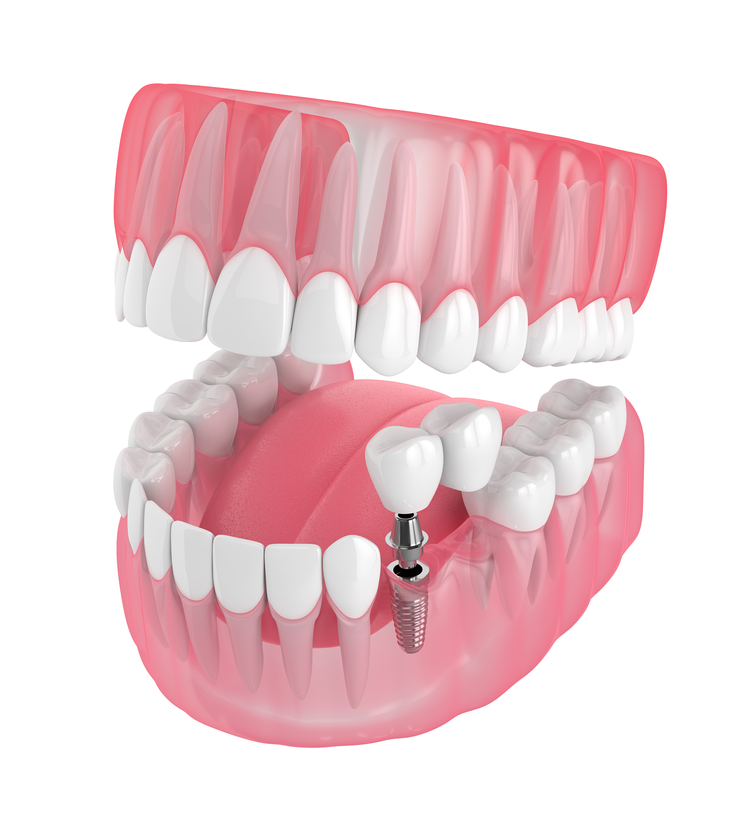 Image related to a dental practice located in Kansas City, KS called Moreno Family Dentistry