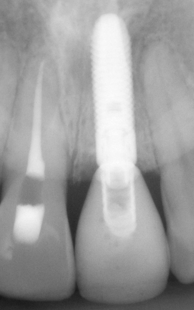 Fractured Teeth Trailhead Dental Wheat Ridge, CO