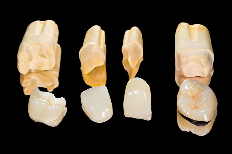 Porcelain Onlays in Sacramento, CA Sandra Fouladi Porcelain Onlays