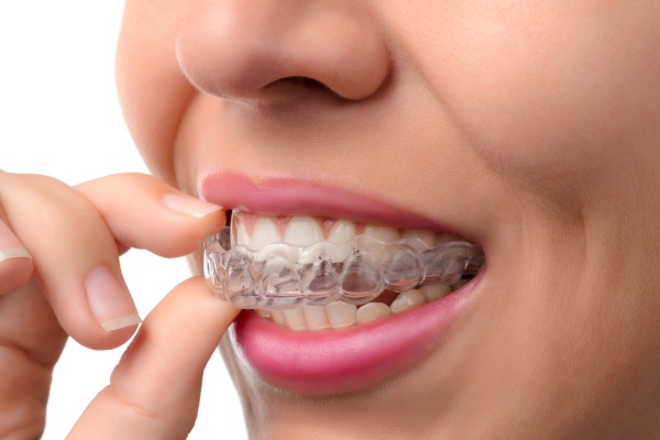 Is Invisalign Really Worth It?