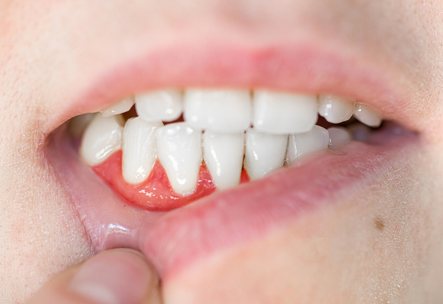 Combatting Periodontal Disease Understanding Treating And Preventing Gum Problems Sugar