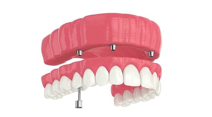 Invisalign (Clear Braces) Las Vegas Henderson NV