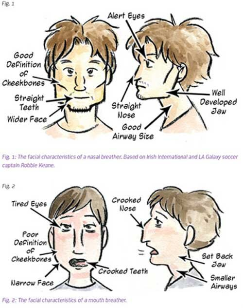 adenoid facies features