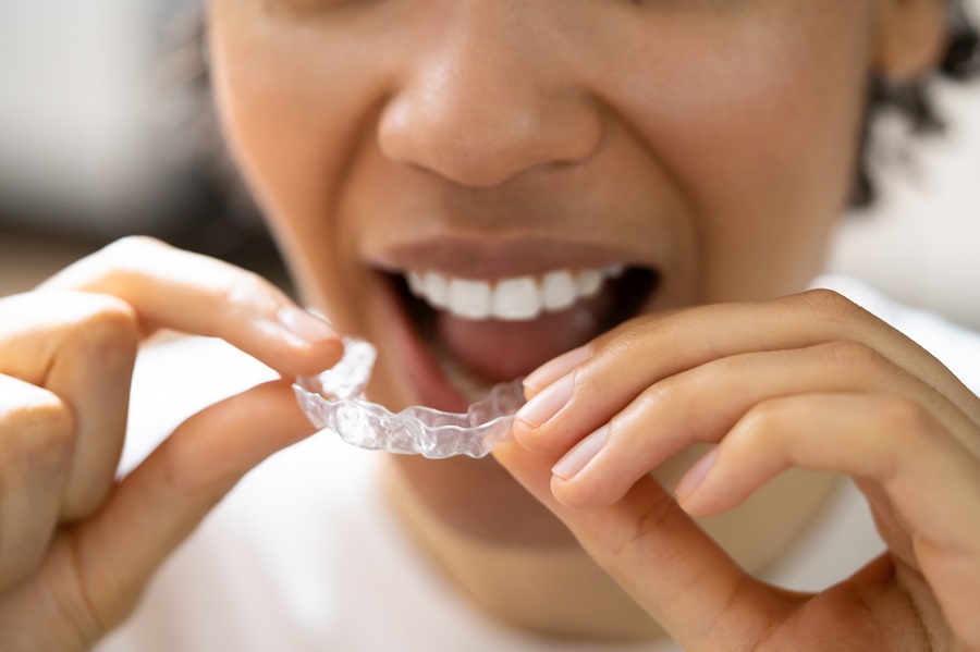 Clear Aligners