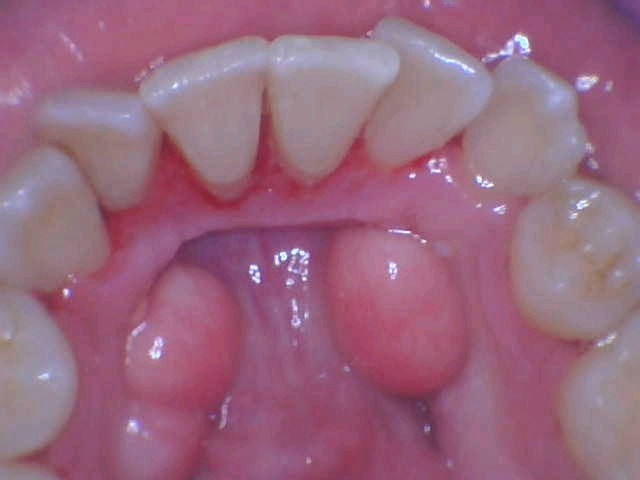 Periodontal Disease Treatment  Picacho Family Dental Implant