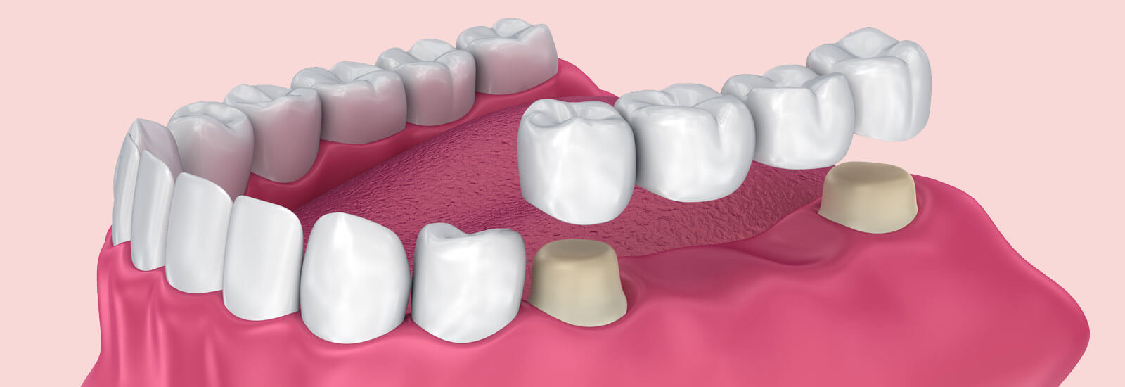 dental bridge procedure