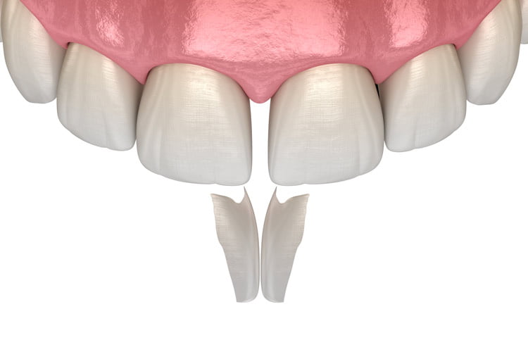 Dental Bonding: What is Teeth Bonding & What to Expect