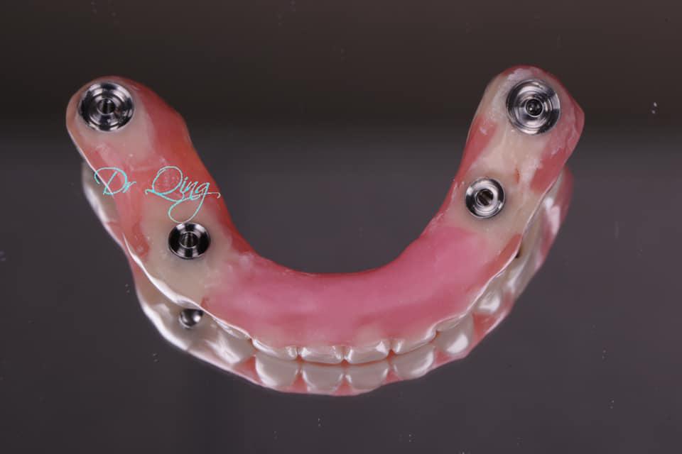 Achieve a Radiant Smile with Zoom Whitening in Lansdale, PA