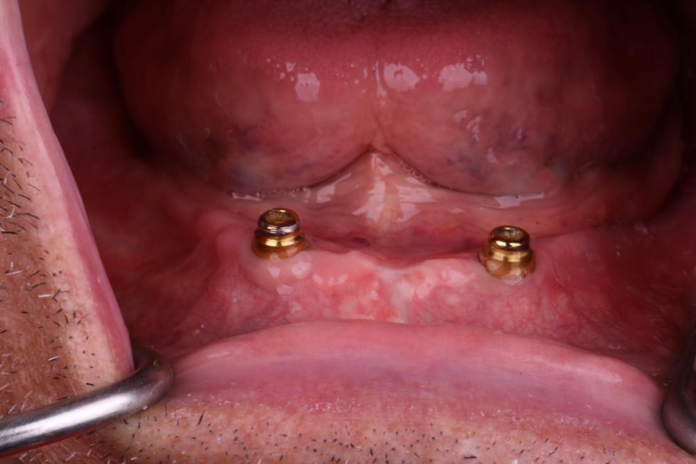 I can eat the corn on the cob nowImplant over denture Bucks Dental