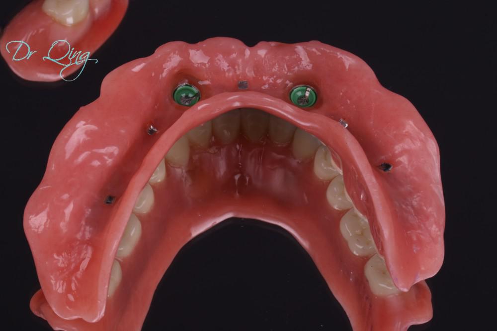 I can eat the corn on the cob nowImplant over denture Bucks Dental