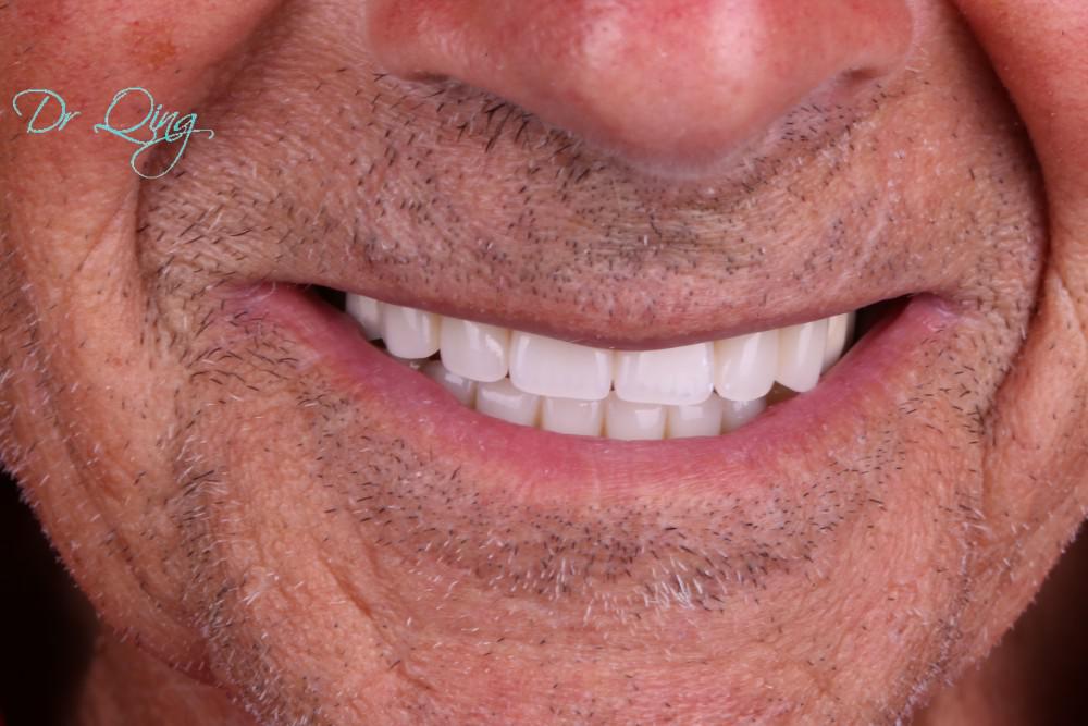 I can eat the corn on the cob nowImplant over denture Bucks Dental