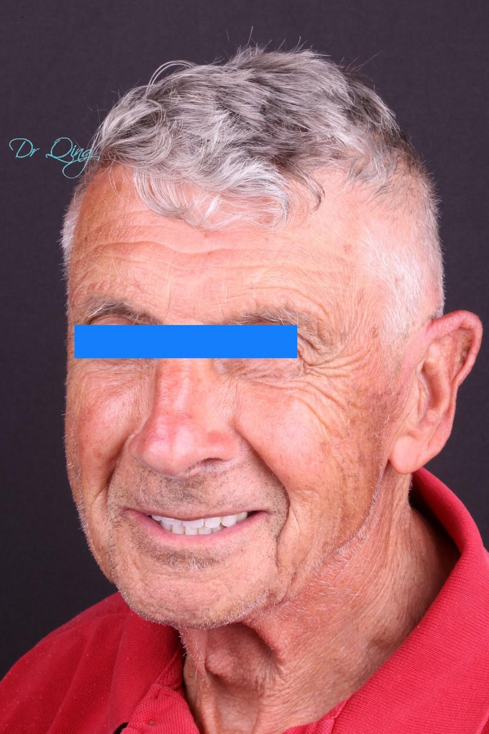 I can eat the corn on the cob nowImplant over denture Bucks Dental