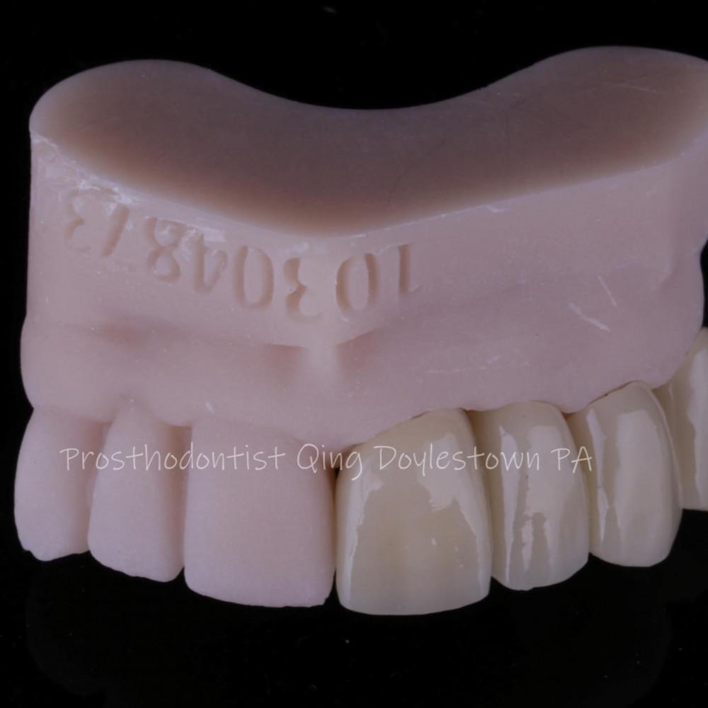 Longterm provisional crowns for terminal stage cancer patients Bucks