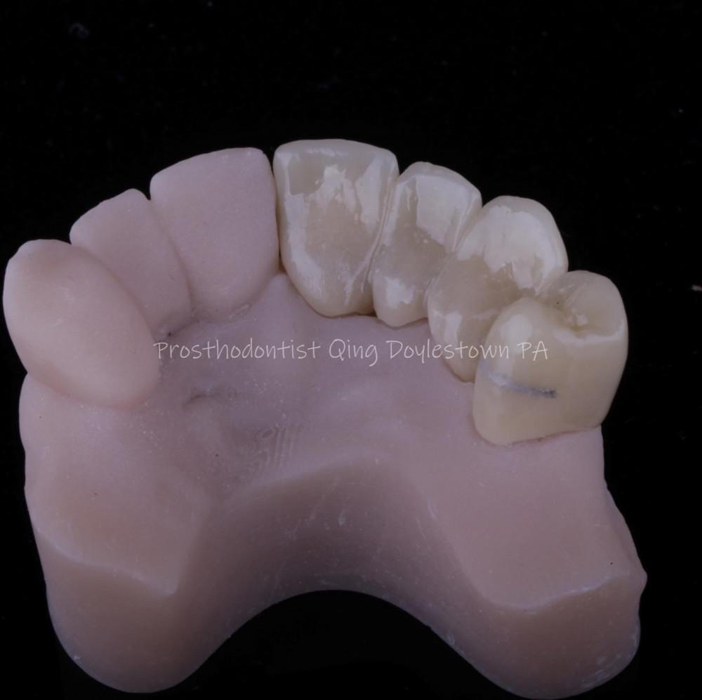 Longterm provisional crowns for terminal stage cancer patients Bucks