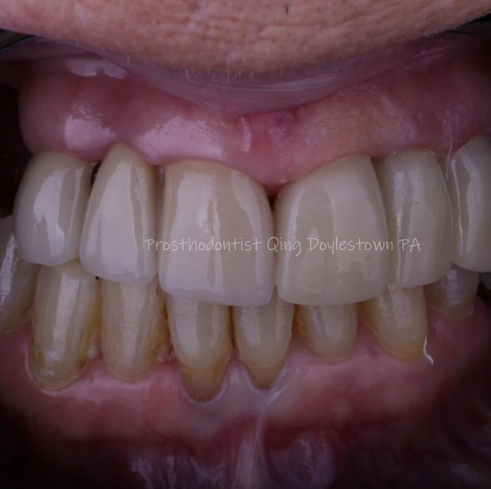 Longterm provisional crowns for terminal stage cancer patients Bucks