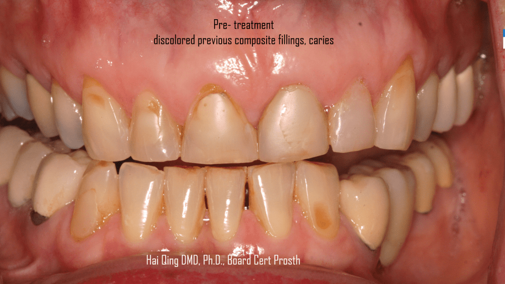 Cosmetic Ceramic Veneers Pros, Cons and Maintenance Bucks Dental