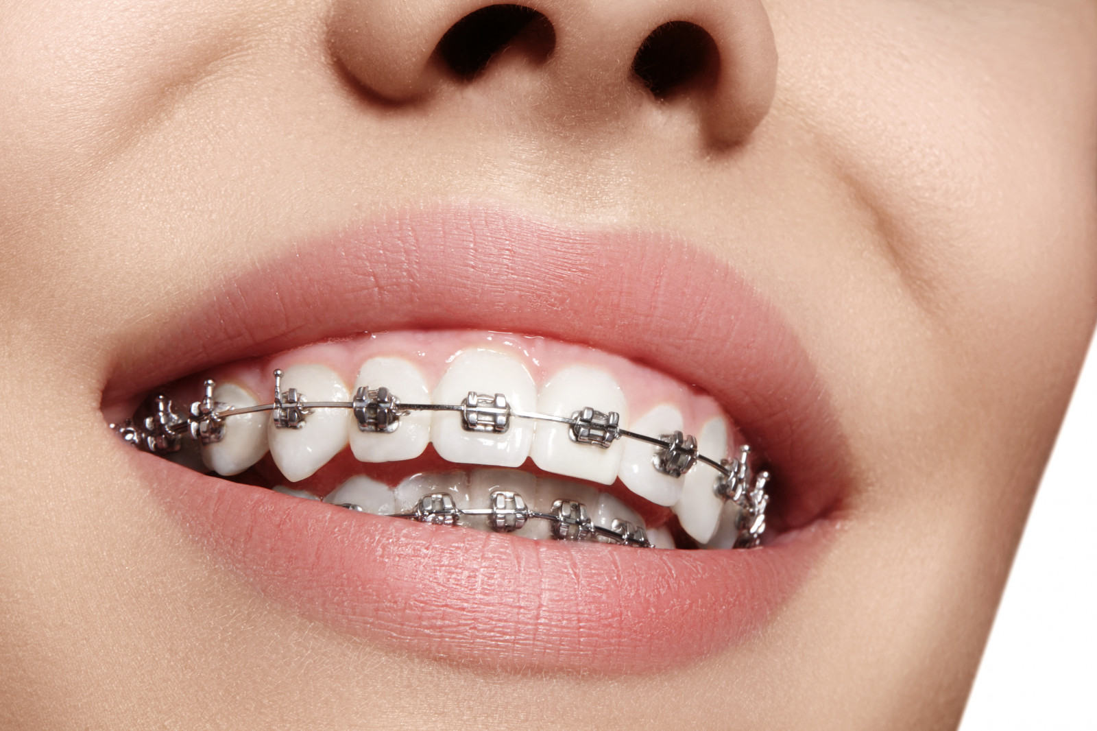 Metal Braces Whittier CA, Traditional Braces Whittier