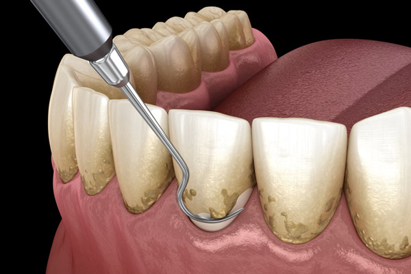 Can I Get a Deep Cleaning With Braces?