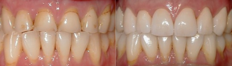 before after images