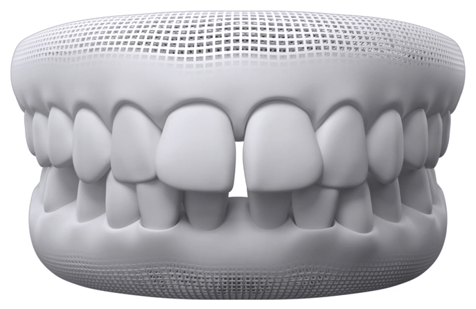 Gaps Between Teeth