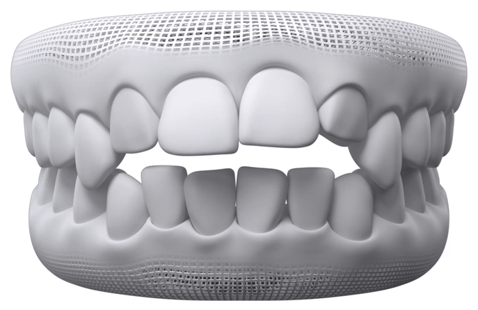 Open Bite