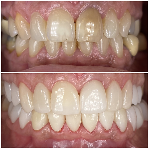 Smile Before & After