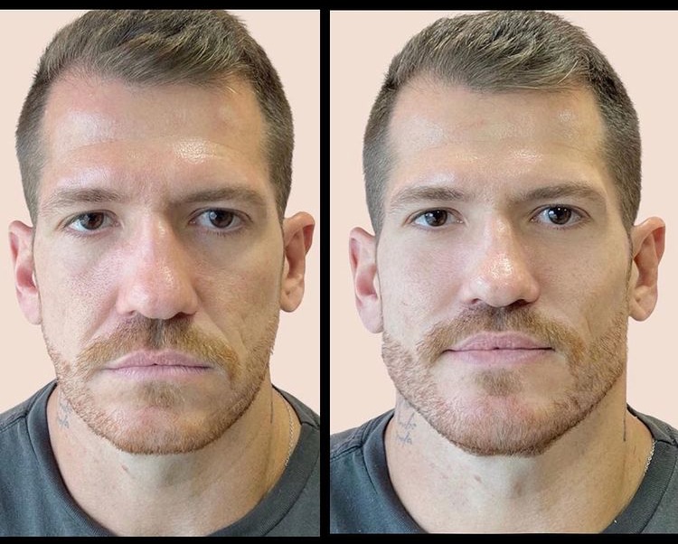 This is a thumbnail image of blog HYALURONIC ACID: THE KEY TO YOUNG AND SYMMETRIC FACE. This is a thumbnail image of blog HYALURONIC ACID: THE KEY TO YOUNG AND SYMMETRIC FACE.