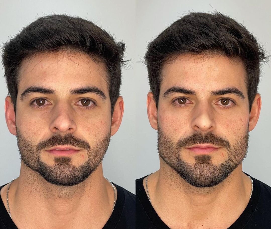 This is a thumbnail image of blog HYALURONIC ACID: THE KEY TO YOUNG AND SYMMETRIC FACE. This is a thumbnail image of blog HYALURONIC ACID: THE KEY TO YOUNG AND SYMMETRIC FACE.