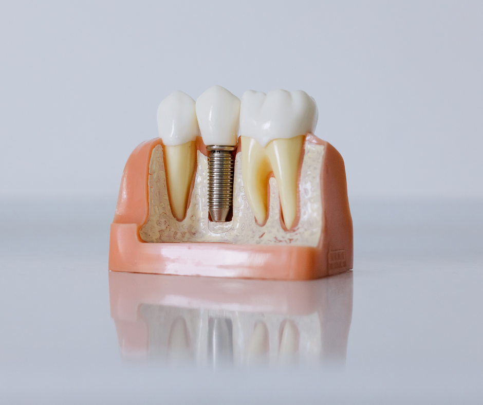 How Painful Are Dental Implants?