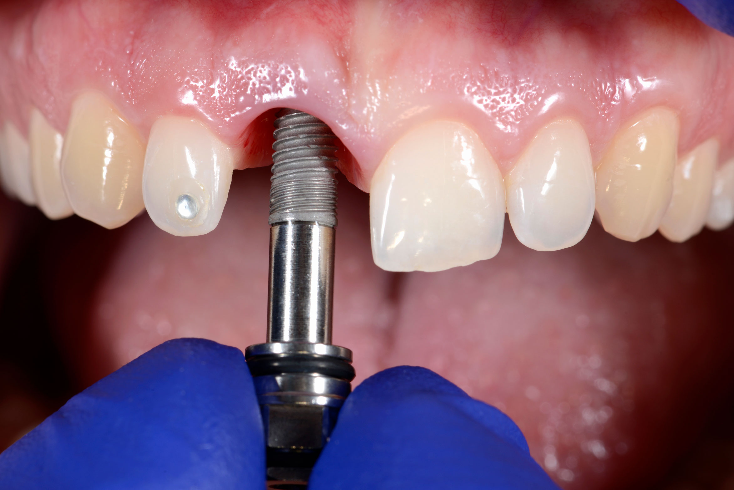 dental-implants-in-virginia-beach-va-dental-implants-in-chesapeake