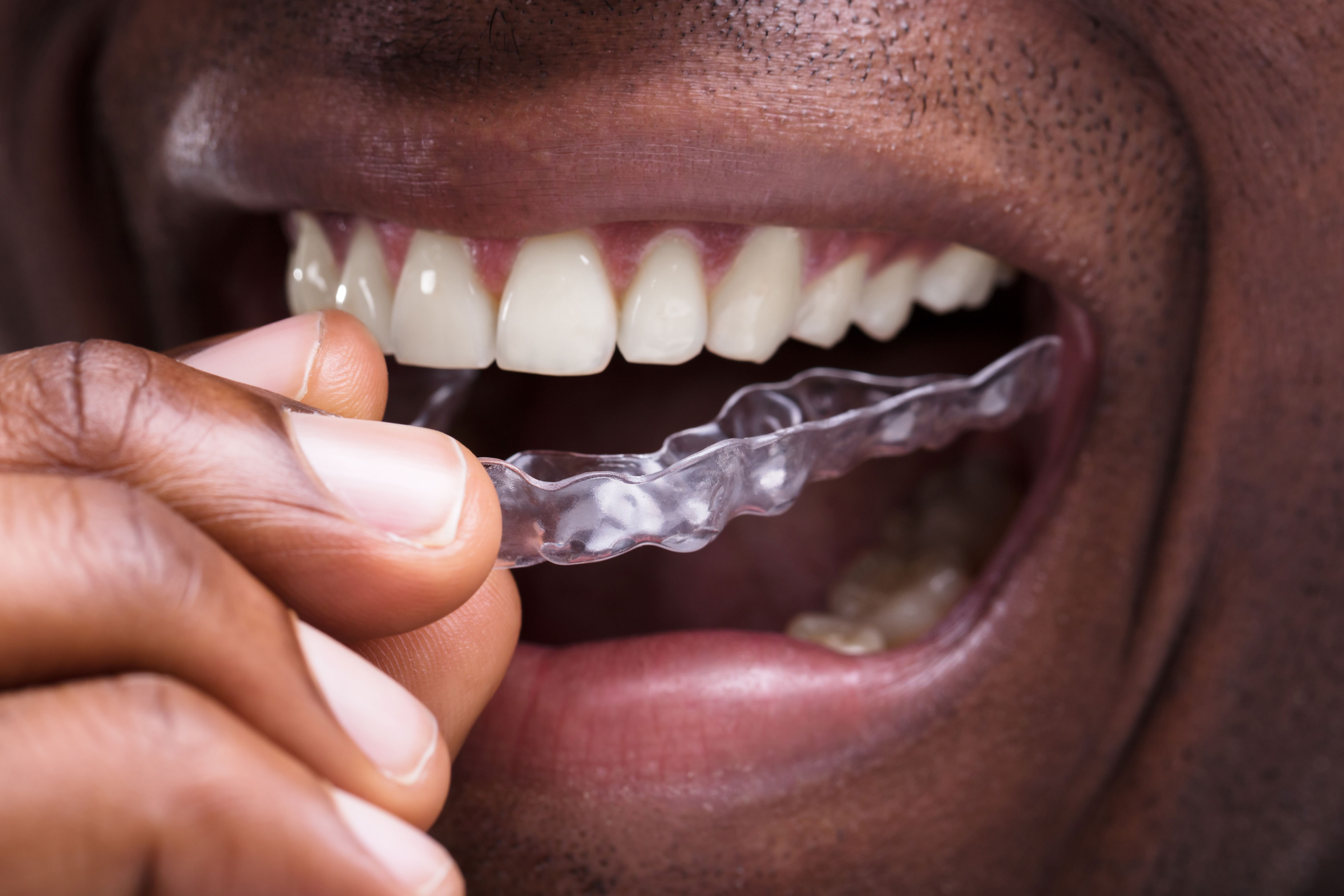 Invisalign for Overbite - Virginia Beach, VA