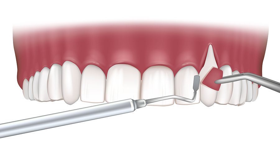 This is a thumbnail image of blog Revitalize Your Smile with Gum Grafting in The Woodlands, TX