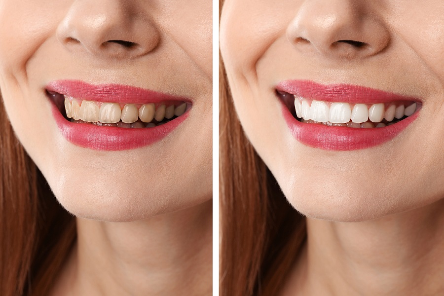 Comparing Take Home Trays vs. In Office Teeth Whitening