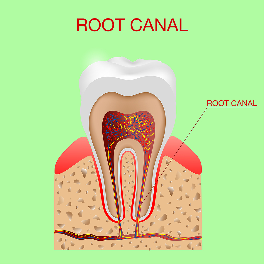 Can a Root Canal Procedure Save My Tooth? Osuna Dental Care Albuquerque, NM