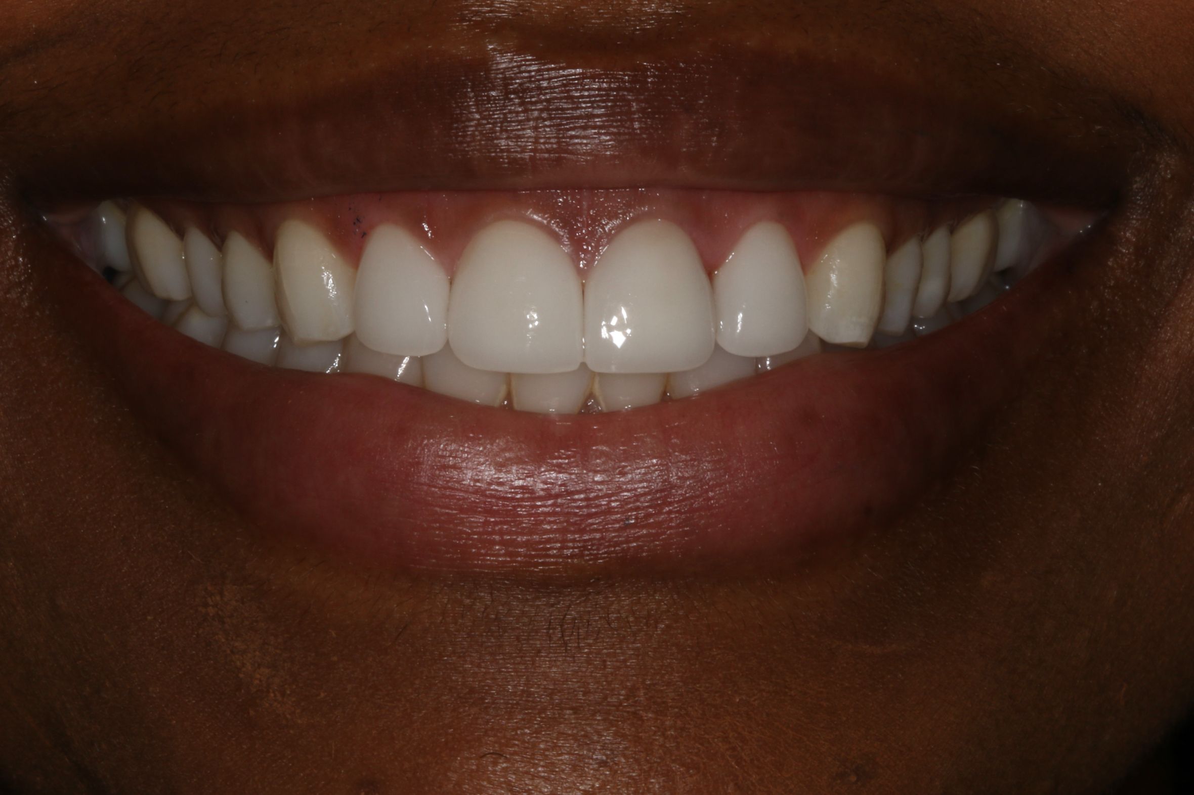 After Prepless Veneers After Prepless Veneers