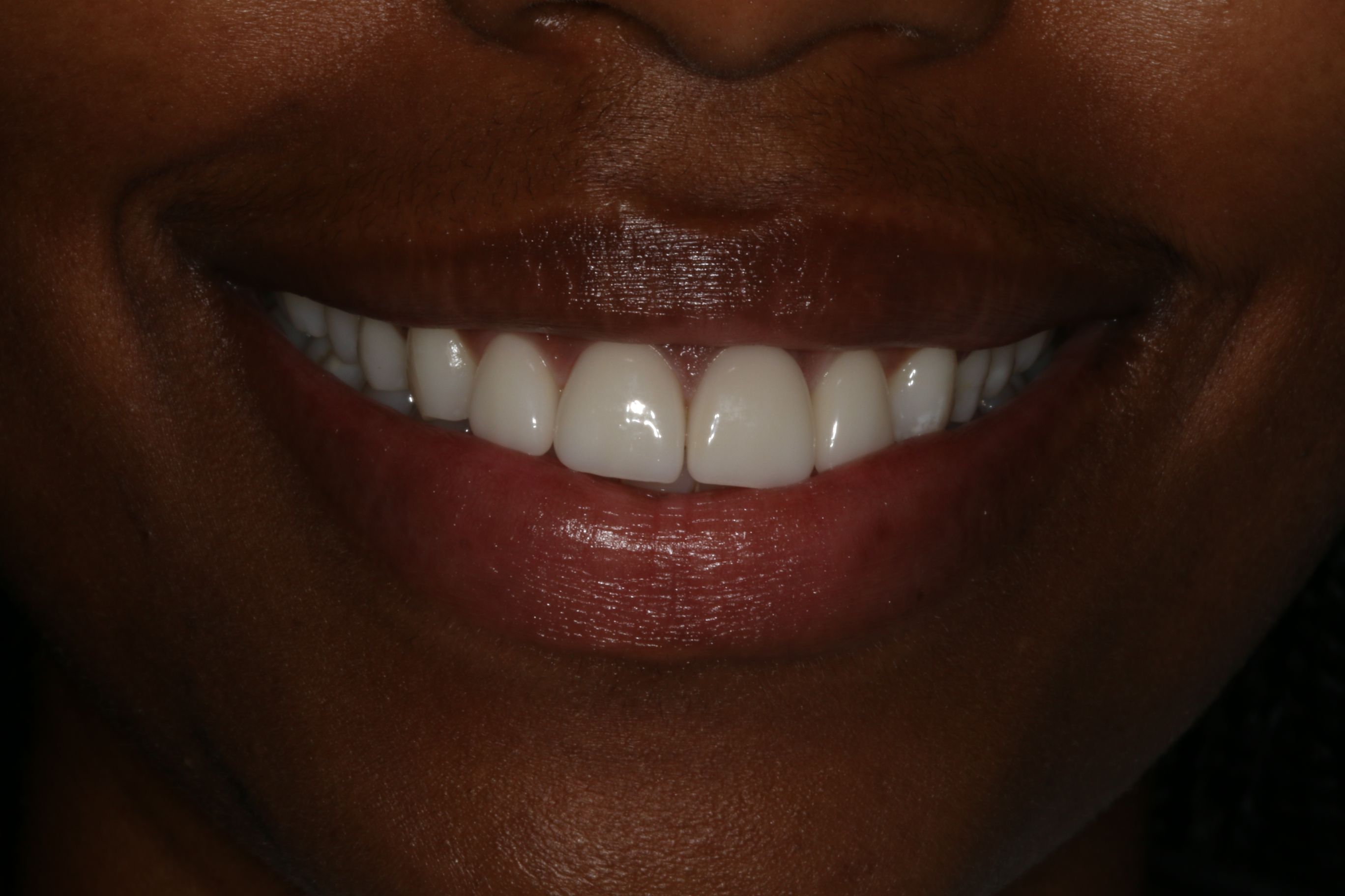 Before Prepless Veneers Before Prepless Veneers