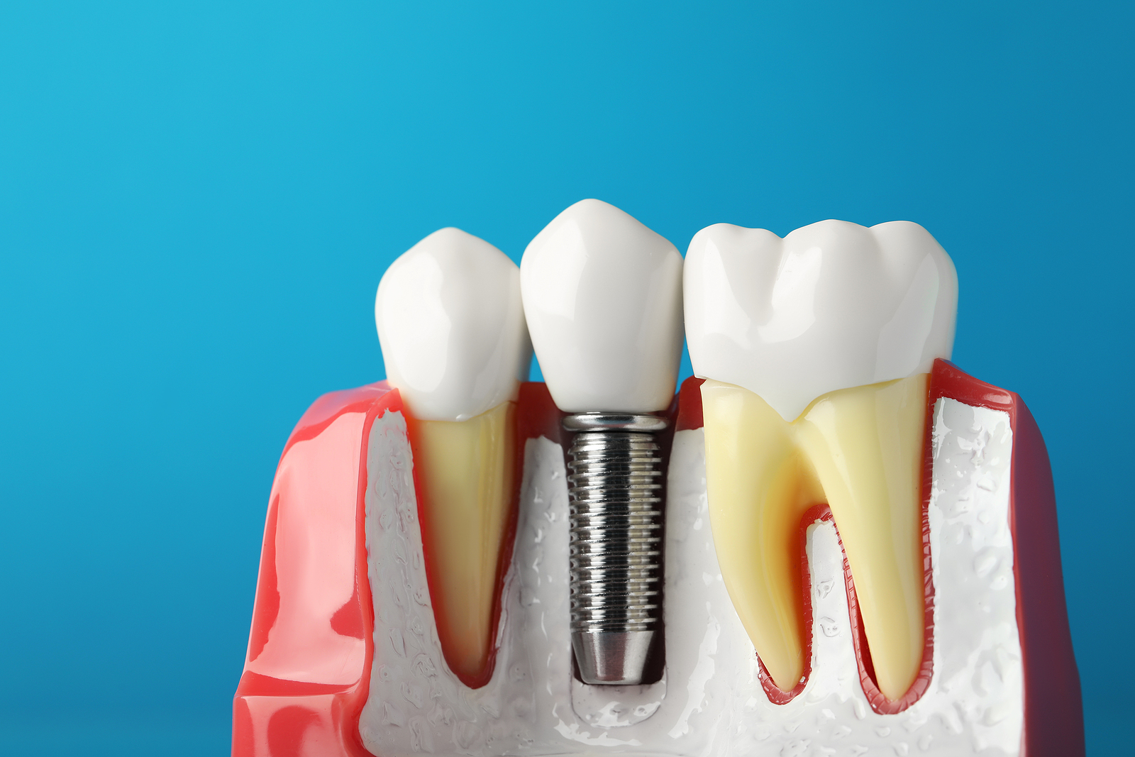 Dental Implants Plantation, Orthodontic Implants