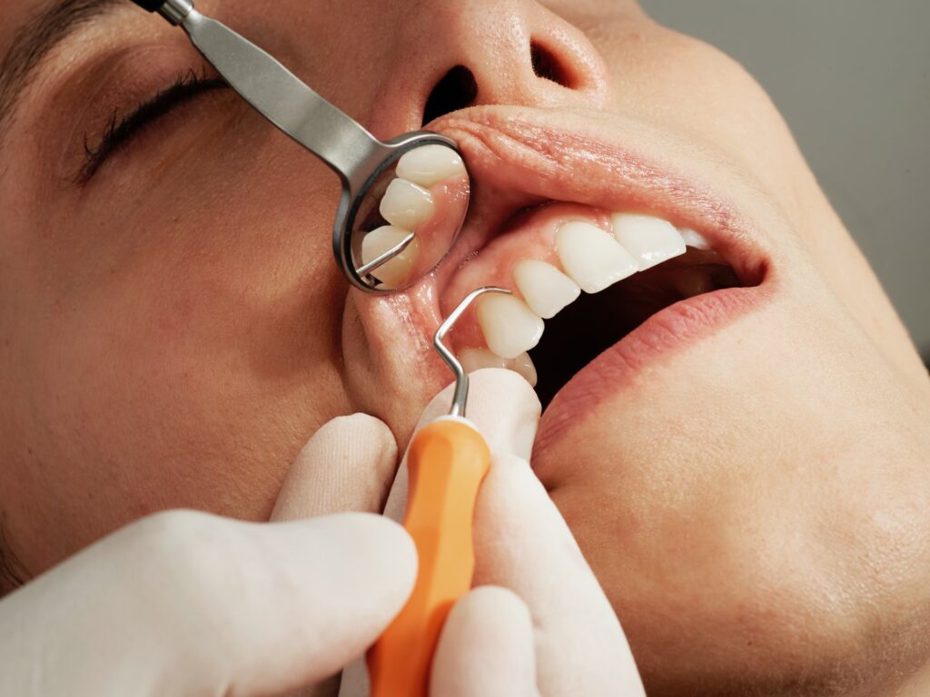 Dental Bonding in Palm Beach Gardens FL, Gardens Dental Spa