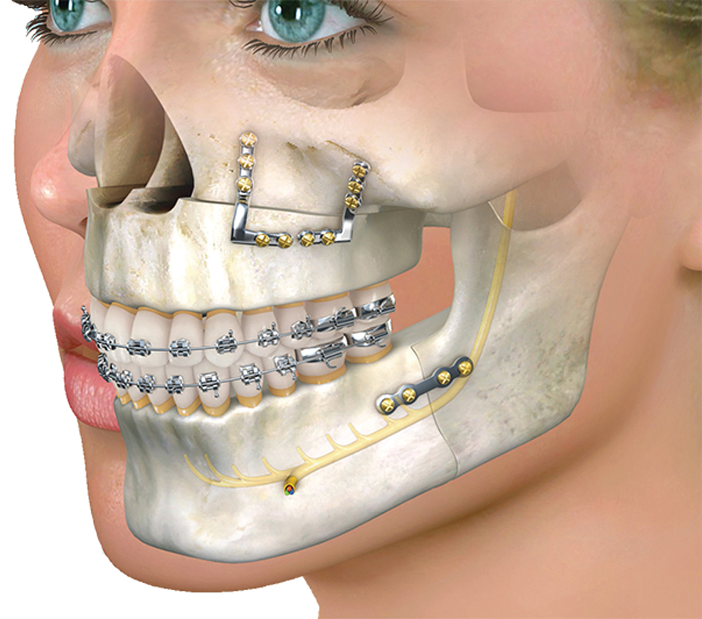 Oral Surgery In Palm Beach Gardens FL | Gardens Dental Spa | Oral Surgery In 33410