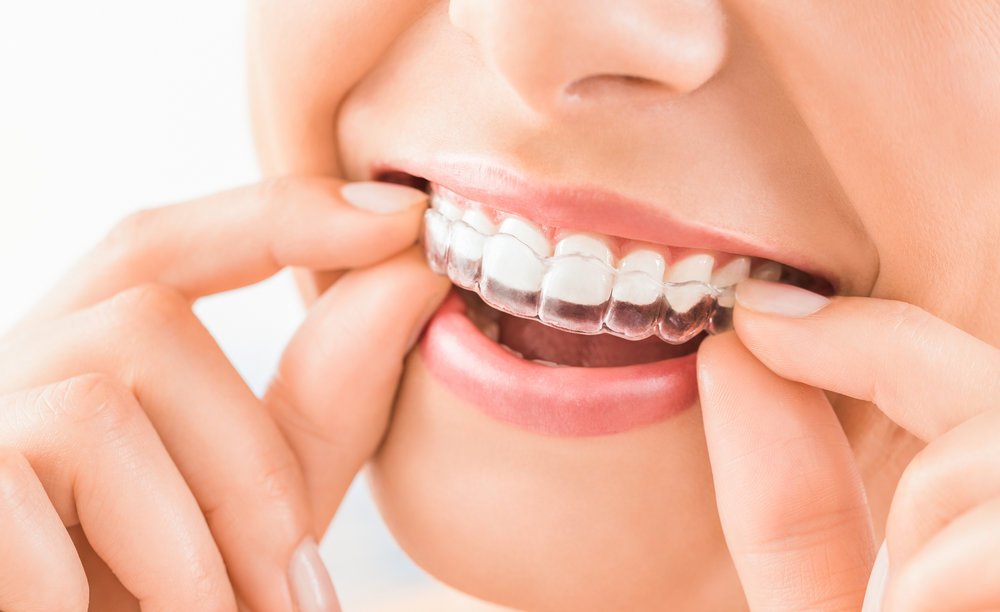 Invisalign vs. Braces  Farmington Dental & Orthodontics
