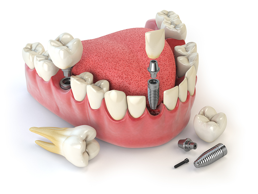 This is a thumbnail image of blog Reclaim Your Smile with Long-Lasting Dental Implants in Farmington, UT This is a thumbnail image of blog Reclaim Your Smile with Long-Lasting Dental Implants in Farmington, UT