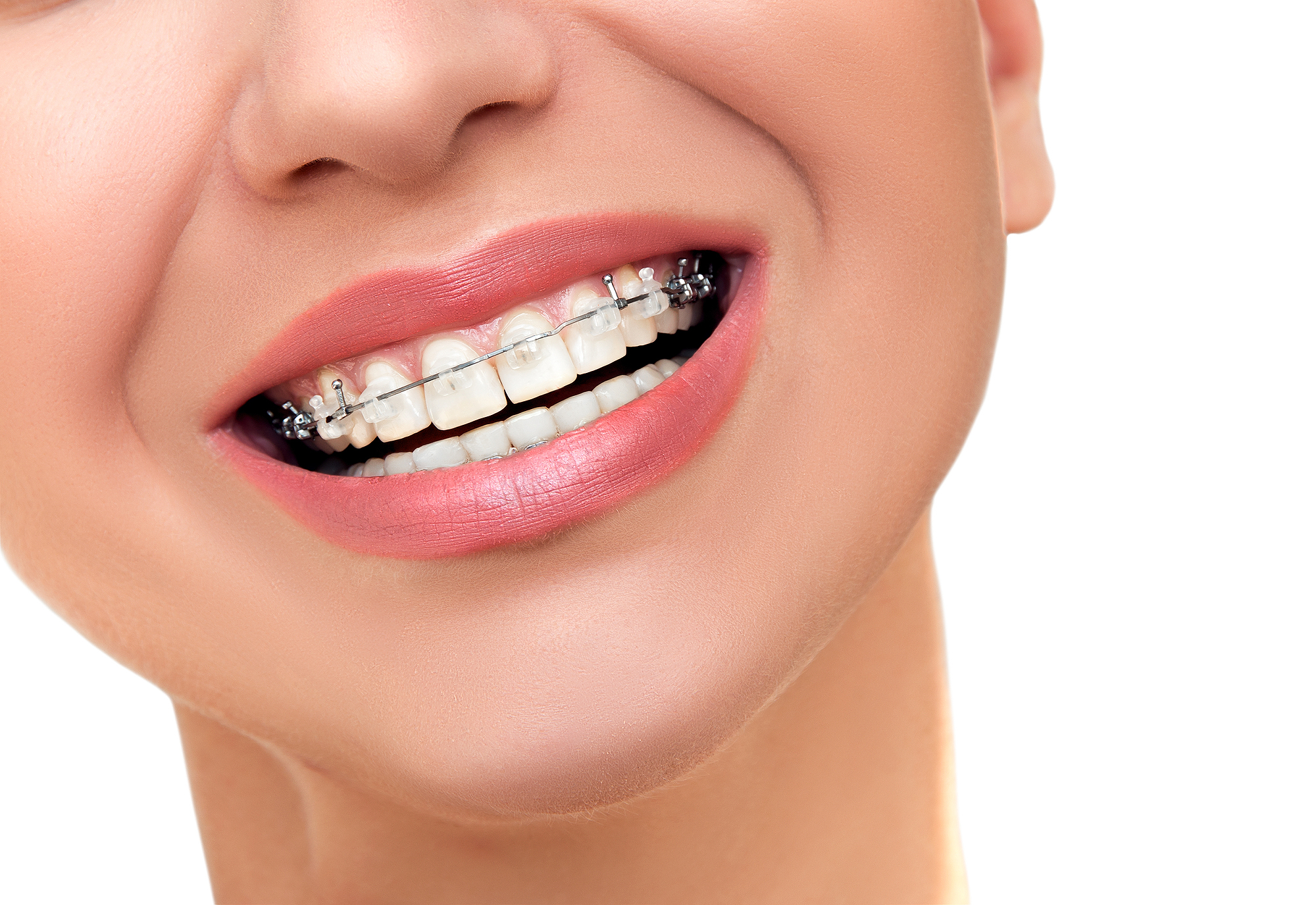 This is a thumbnail image of blog Achieving a Perfect Smile: Orthodontics in Farmington, UT