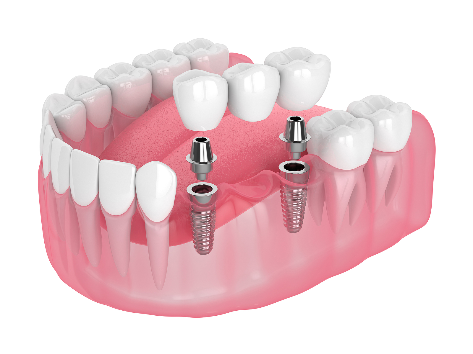 Dental Implants Whole Mouth Grandville MI