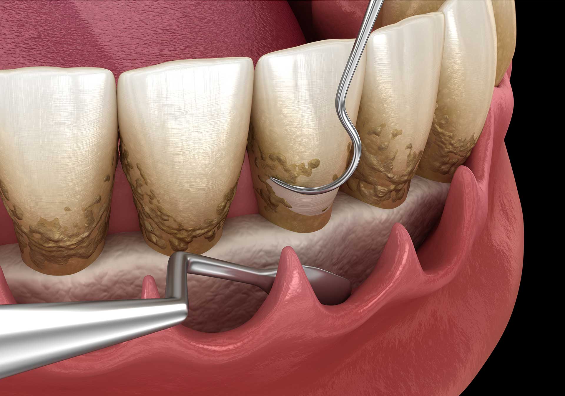 Scaling and Root Planing Dental Specialists & Implant Center at the