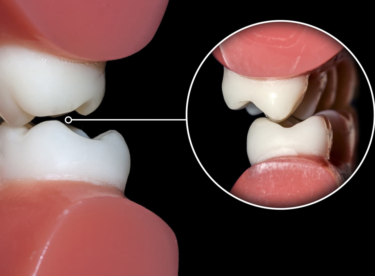 Philadelphia Cavities During Invisalign®: Tooth Decay and